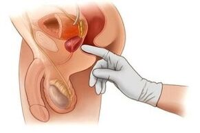 diagnosis rectal of prostatitis