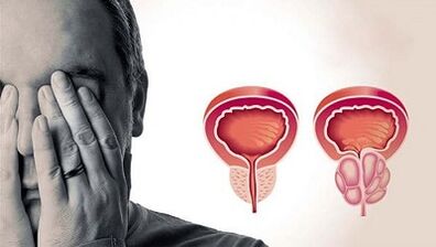 Alesan pikeun pamekaran prostatitis dina lalaki