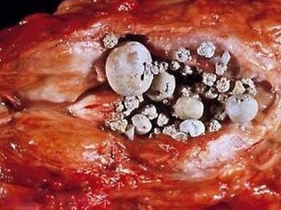 Batu dina kelenjar prostat kalawan prostatitis calculous