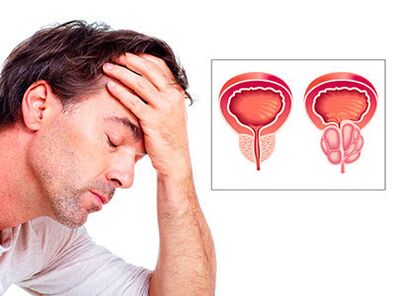 Gejala prostatitis salempang lalaki